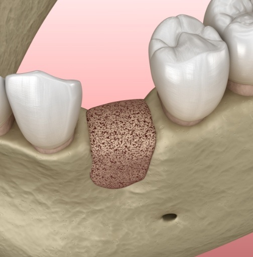 Animated smile with bone grafting material in place