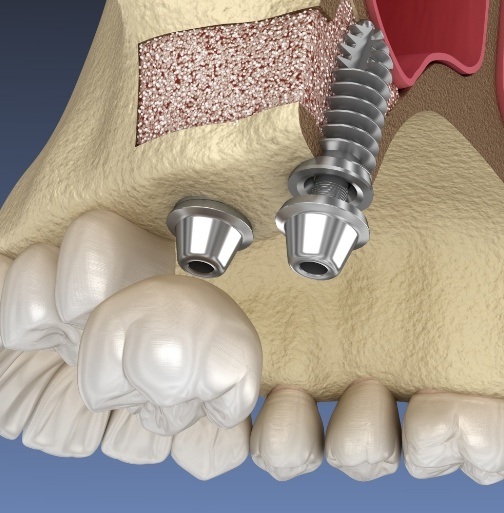Animated smile with dental implant placed into grafted bone