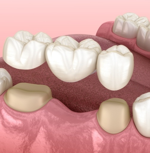 Animated smile during dental bridge placement