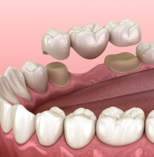 Animated smile during dental crown supported bridge placement