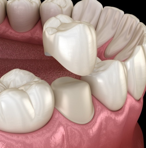 Animated smile during dental crown placement