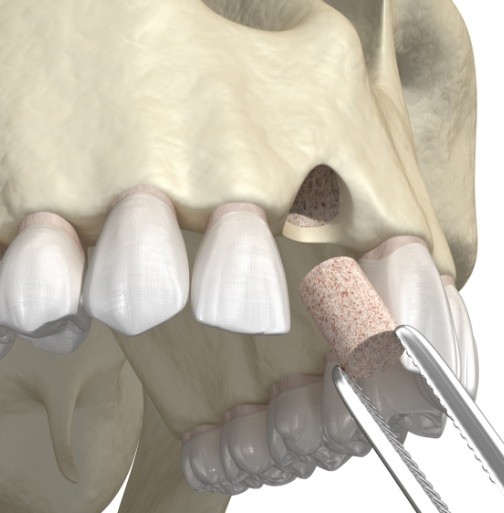 Animated smile during bone grafting prior to dental implant tooth replacement