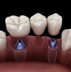 Animated dental implant supported fixed bridge placement