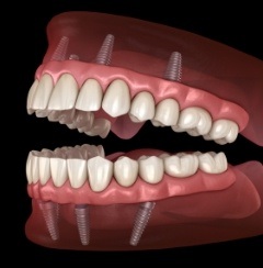 Animated smile with full set of dental implant retained dentures