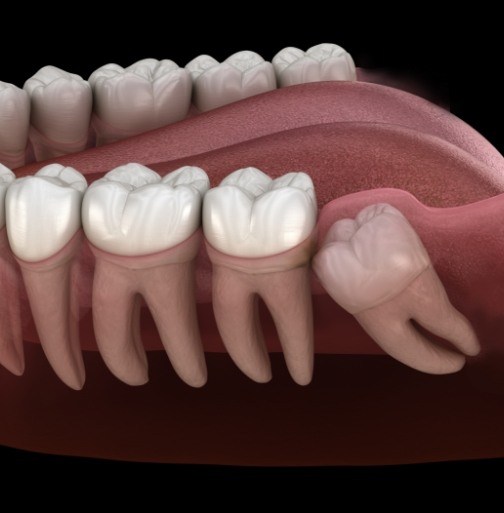 Animated smile showing impacted wisdom tooth in need of extraction
