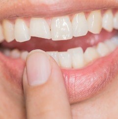 Smile with chipped front tooth