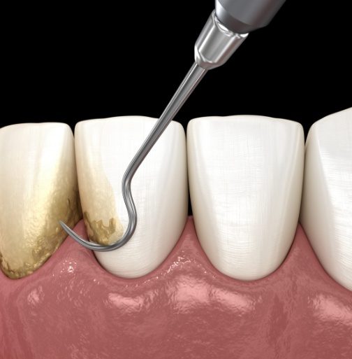 Animated smile during scaling and root planing treatment