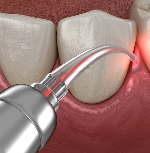 Animated smile during laser gum disease treatment