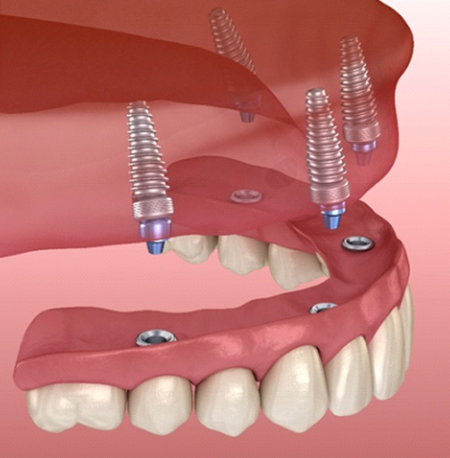 implant denture on the upper arch