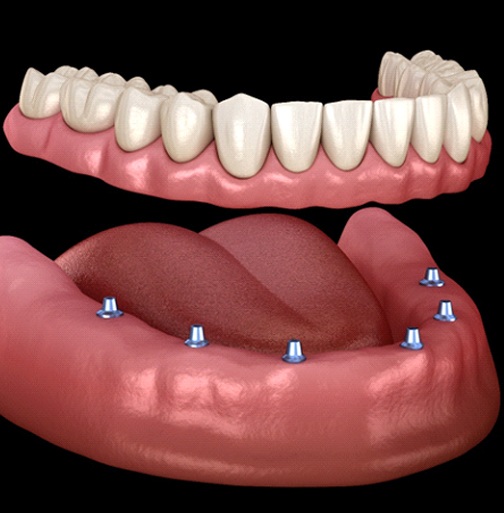 implant denture on the lower arch