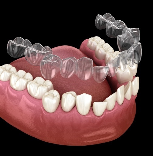 Animated smile during Invisalign treatment