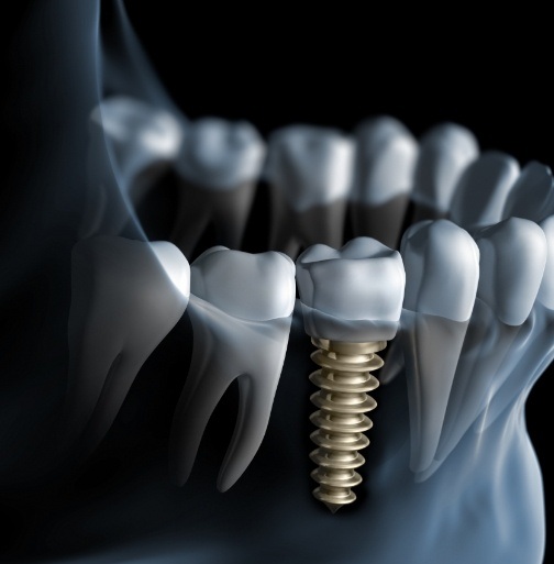 Animated smile with dental implant supported dental crown