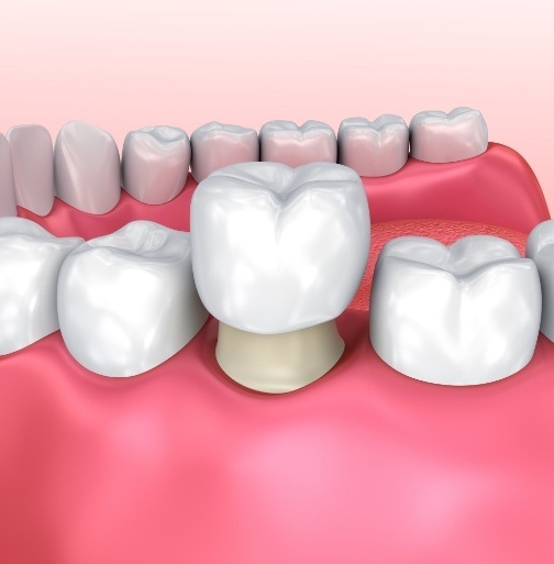 Animated smile during dental crown placement