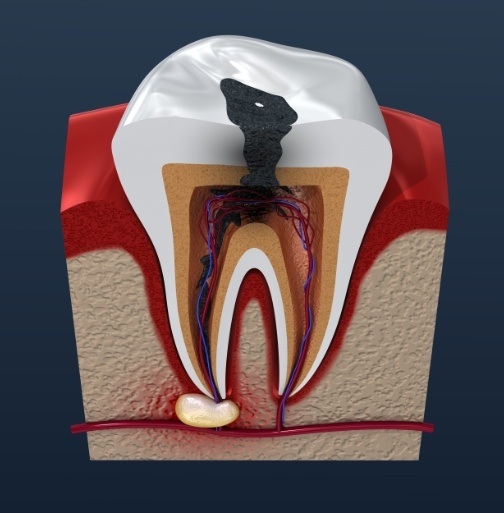 Animated tooth in need of root canal therapy