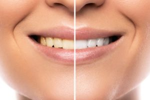 Before and after teeth whitening