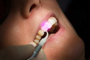 Close up of dental laser on patient's smile