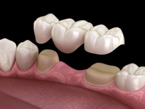 Model of a dental bridge with black background