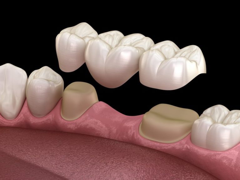 How Long Do Dental Bridges Last? Cedar Mountain Dental