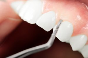 Close up of healthy gums during dental exam