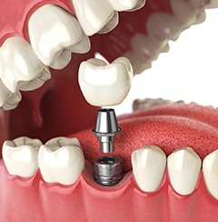 dental implant rendering