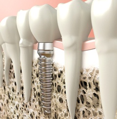 Dental implant in Newington